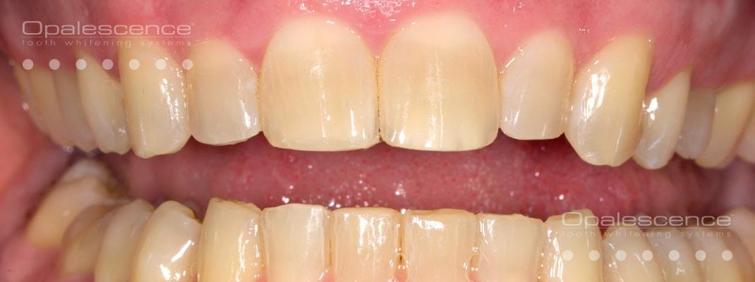Ennen Opalescence hampaiden valkaisujärjestelmää